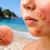 Impetigo